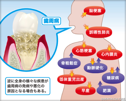 歯周病が招く、身体の病気