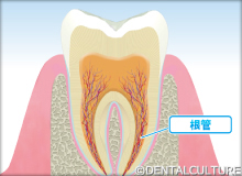 歯の根の治療